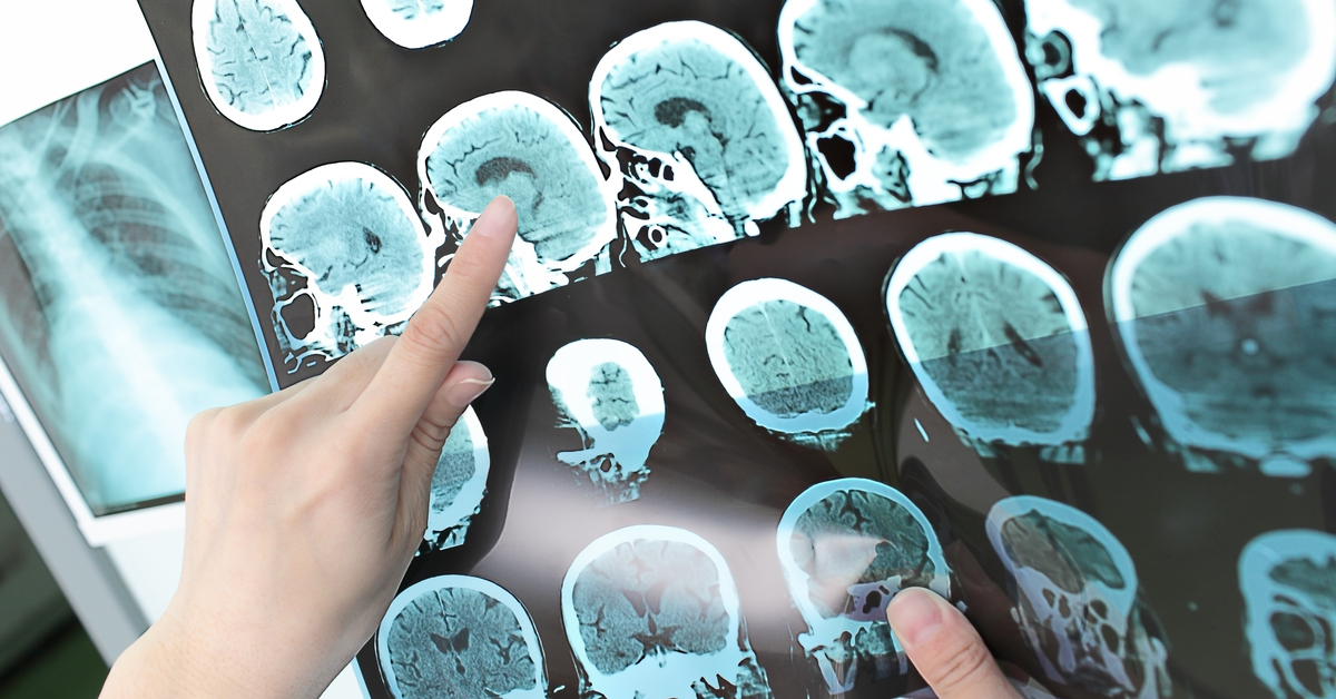 Alzheimer hastalığını yavaşlatacak bilimsel çalışmada olumlu sonuç alındı